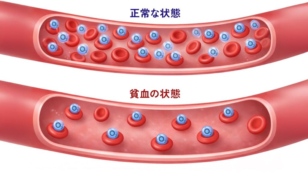 貧血の仕組み図解:正常な血液とヘモグロビンが減少した酸素不足の血液比較